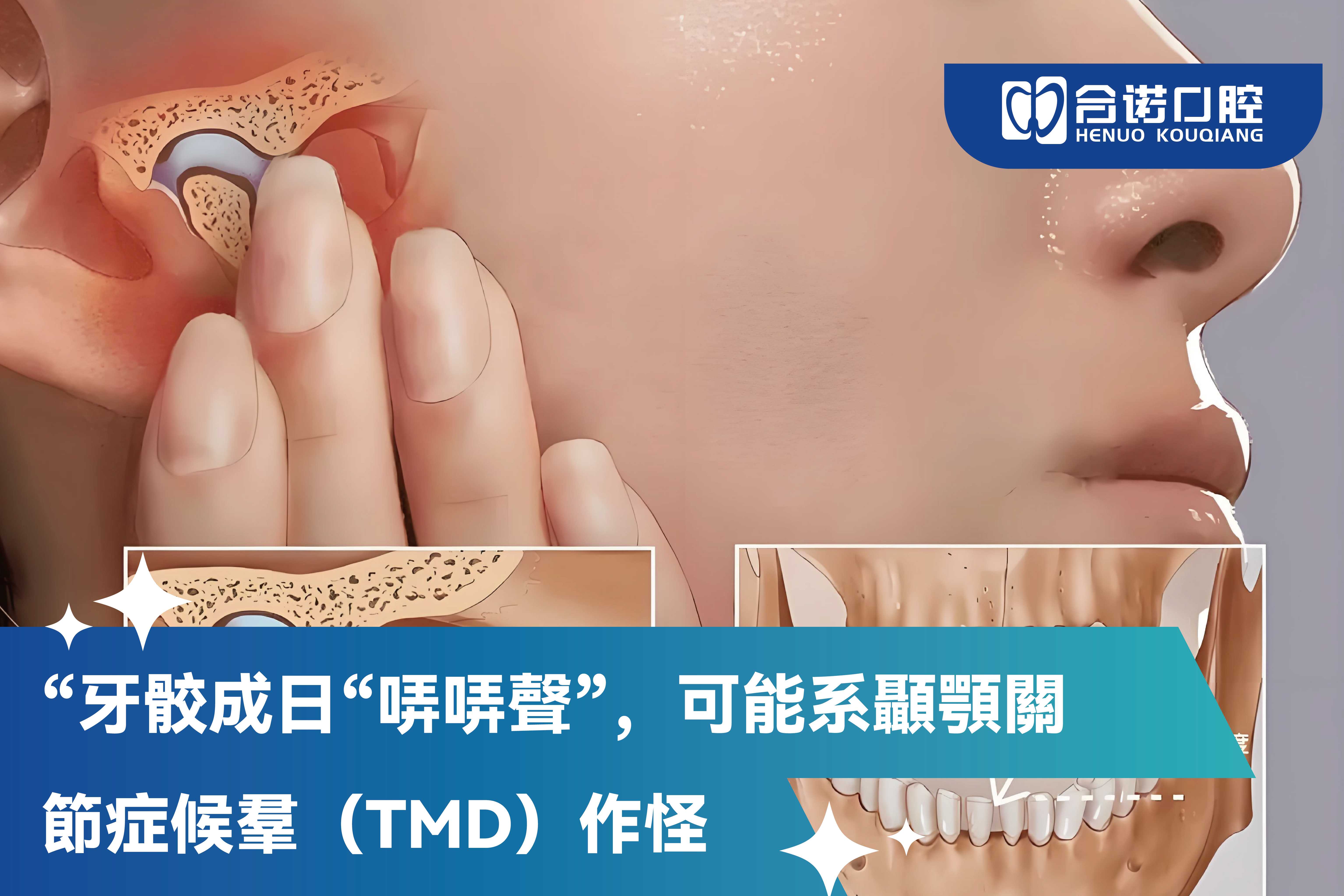 牙骹成日“咔咔聲”，可能系顳顎關節症候羣(TMD)作怪