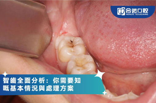 ​智齒全面分析：你需要知嘅基本情況與處理方案