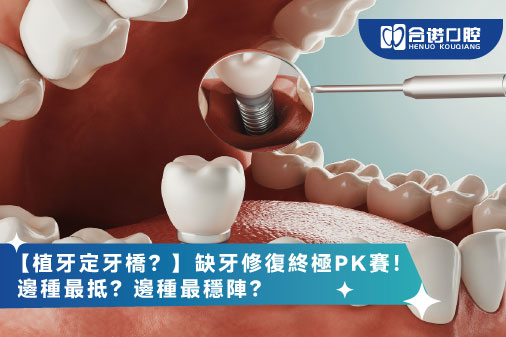 【植牙定牙橋？】缺牙修復終極PK賽！邊種最抵？邊種最穩陣？