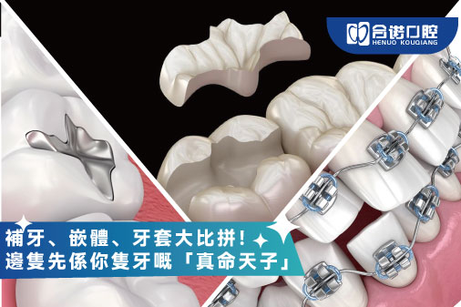 補牙、嵌體、牙套大比拼！邊隻先係你隻牙嘅「真命天子」