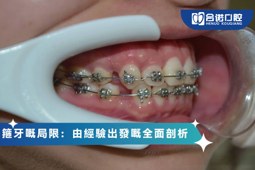 箍牙嘅局限：由經驗出發嘅全面剖析