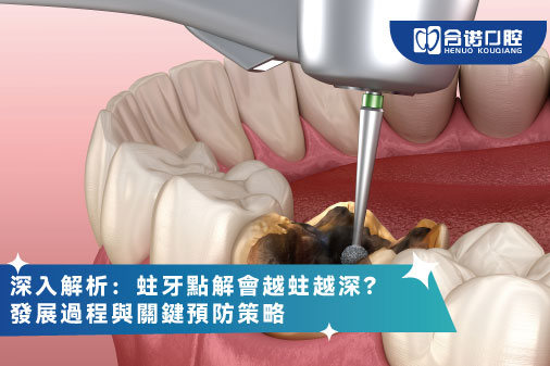 ​深入解析：蛀牙點解會越蛀越深？發展過程與關鍵預防策略