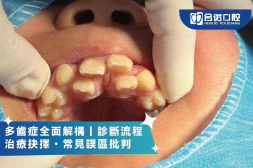 ​多齒症全面解構｜診斷流程・治療抉擇・常見誤區批判