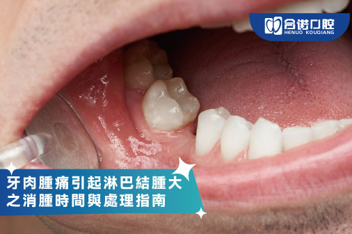 ​牙肉腫痛引起淋巴結腫大之消腫時間與處理指南