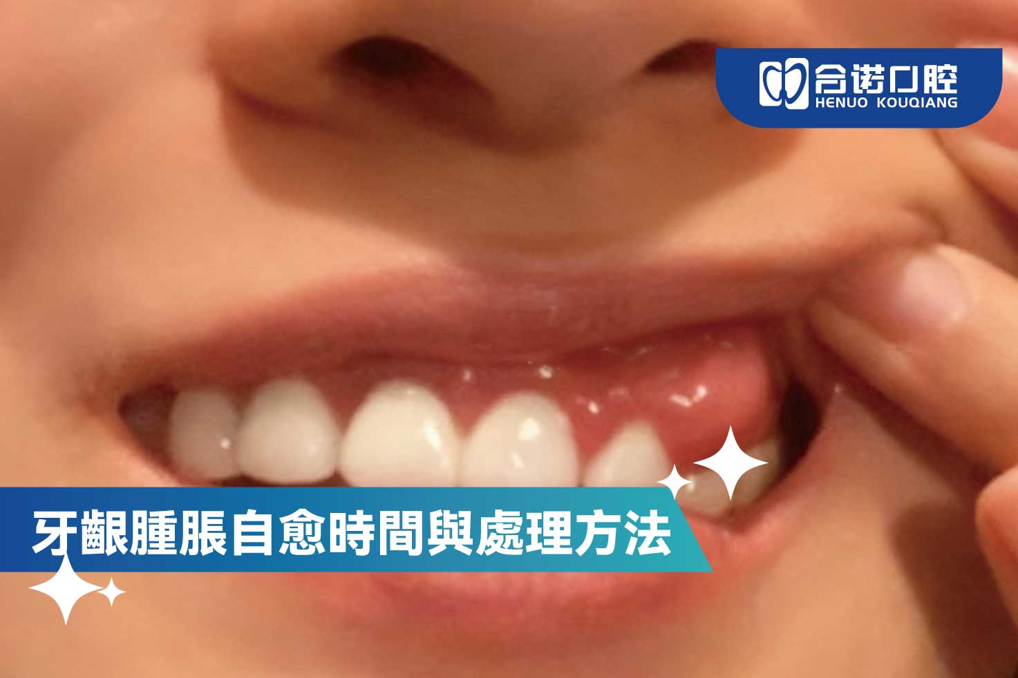 牙齦腫脹自愈時間與處理方法