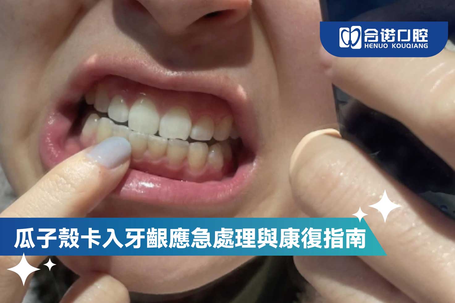 瓜子殼卡入牙齦應急處理與康復指南