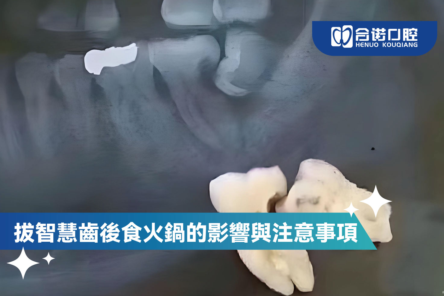 拔智慧齒後食火鍋的影響與注意事項