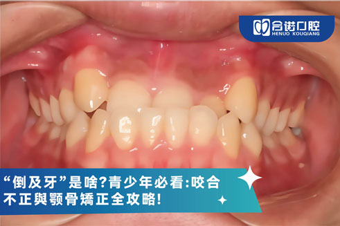 “倒及牙”是啥？青少年必看：咬合不正与颚骨矫正全攻略！