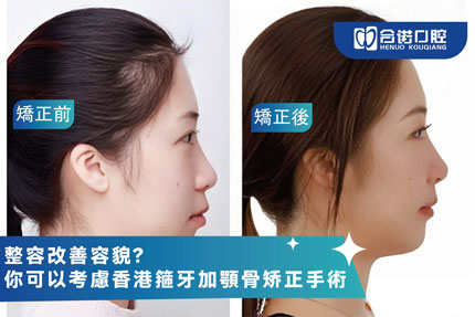 整容改善容貌？你可以考虑香港箍牙加颚骨矫正手术