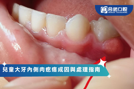 兒童大牙內側肉疙瘩成因與處理指南