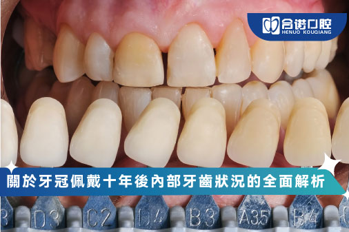 關於牙冠佩戴十年後內部牙齒狀況的全面解析