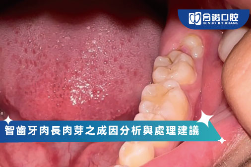 智齒牙肉長肉芽之成因分析與處理建議