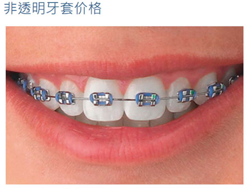 非透明牙套