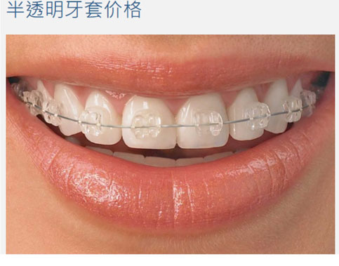 半透明牙套