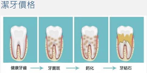 洗牙